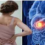 অগ্ন্যাশয়ের ক্যানসারের লক্ষণ