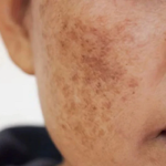 মেছতার কারণ ও চিকিৎসা