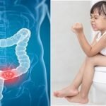 শীতে কোষ্ঠকাঠিন্য রোগীদের সতর্কতা ও করণীয়