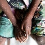 এমপক্স কী? কীভাবে ছড়ায়? এ রোগের লক্ষণ কী?