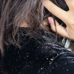 ঘরোয়া উপায়ে সহজে দূর করতে পারেন খুশকি