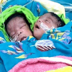 রাজশাহীতে দুই মাথা যুক্ত এক শিশুর জন্ম