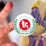 হাম ও উপসর্গে আরও ৭ শিশুর মৃত্যু