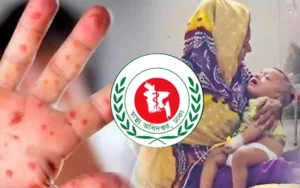 হাম ও উপসর্গে আরও ৭ শিশুর মৃত্যু