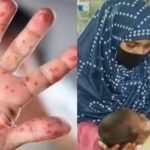 হাম ও উপসর্গে আরো ১০ শিশুর মৃত্যু