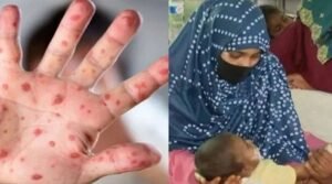 হাম ও উপসর্গে আরো ১০ শিশুর মৃত্যু
