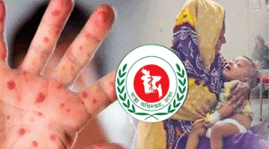 এক দিনে হামের উপসর্গে আরও ৫ শিশুর মৃত্যু